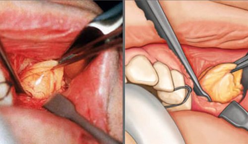 комки биша операция
