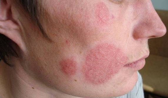 Кожа лица, пораженная грибковой инфекцией