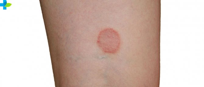 Манту — Если манту покраснела в первый день, советы врачей, фото