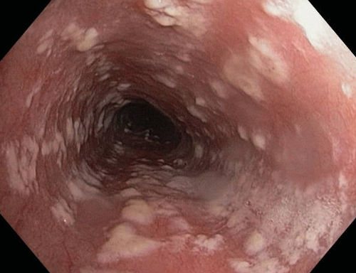 Меню при кандидозе пищевода