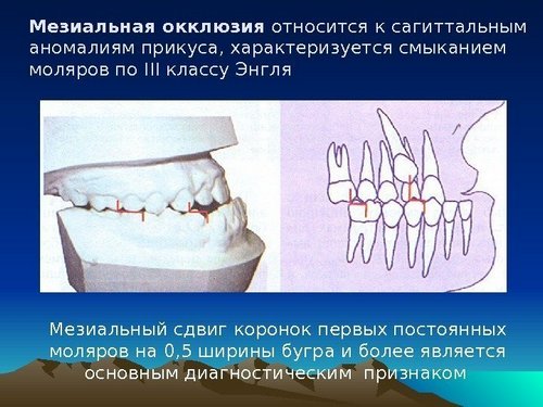 Мезиальный прикус