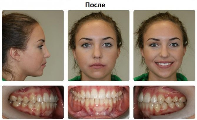 Мезиальный прикус