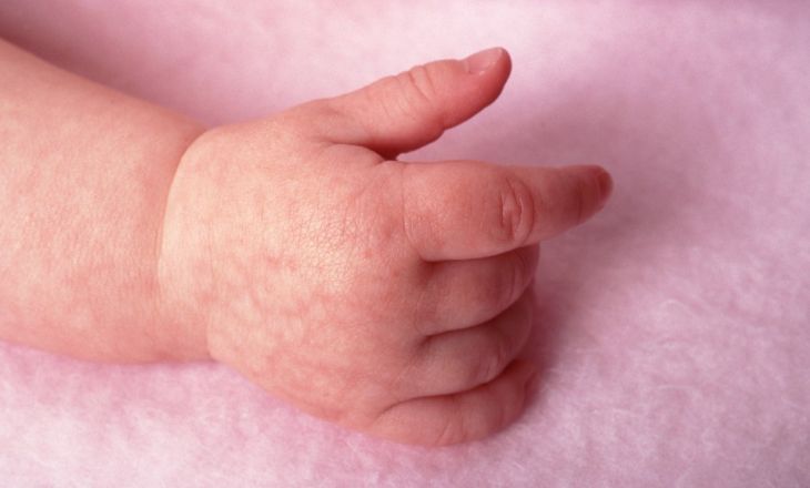 мраморная кожа на руке у ребенка
