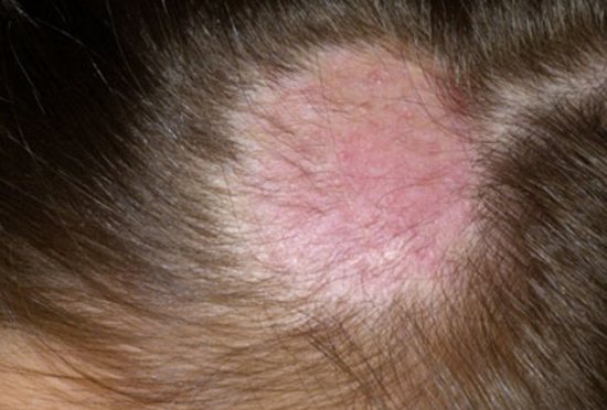 на фото грибок кожи головы