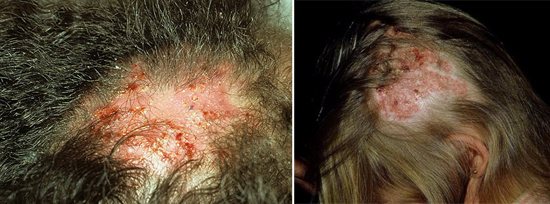 На фото тяжелое течение грибка головы