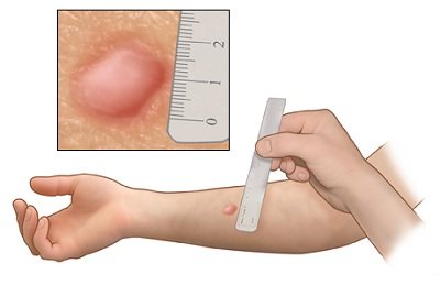 На какой день проверяют диаскинтест у детей