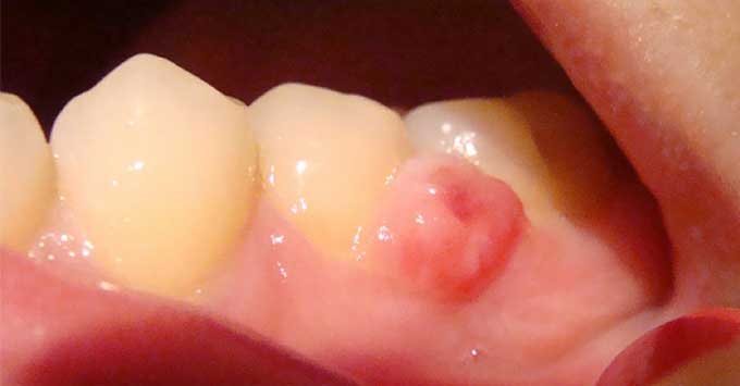 нарост на десне у ребенка