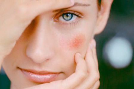 О чем говорят красные пятна на лице