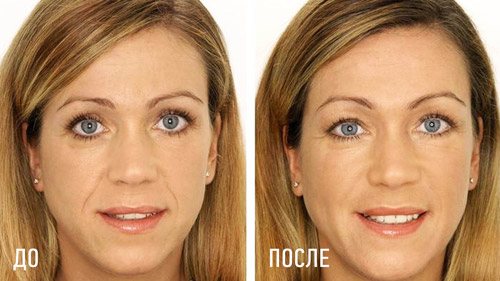 отзыв о мезороллере для лица