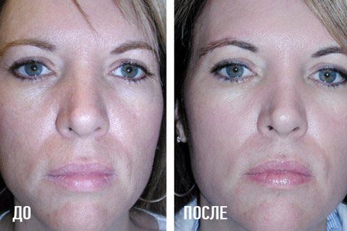 отзыв о мезороллере для лица