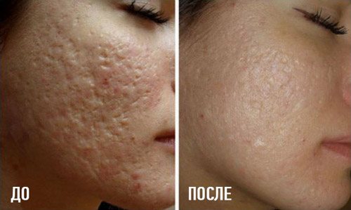 отзыв о мезороллере для лица