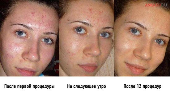 отзыв о мезороллере для лица