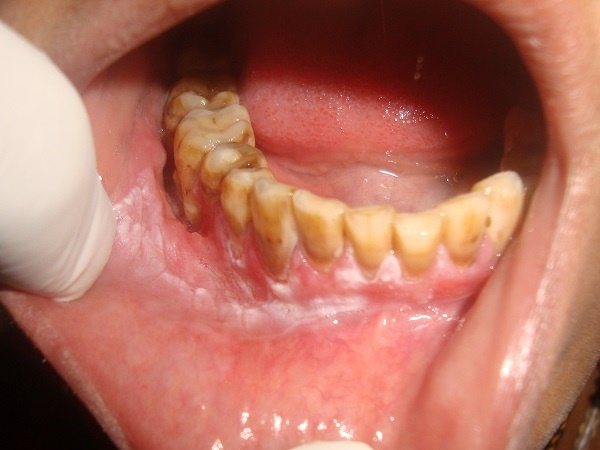 ожог слизистой, как причина эпулиса
