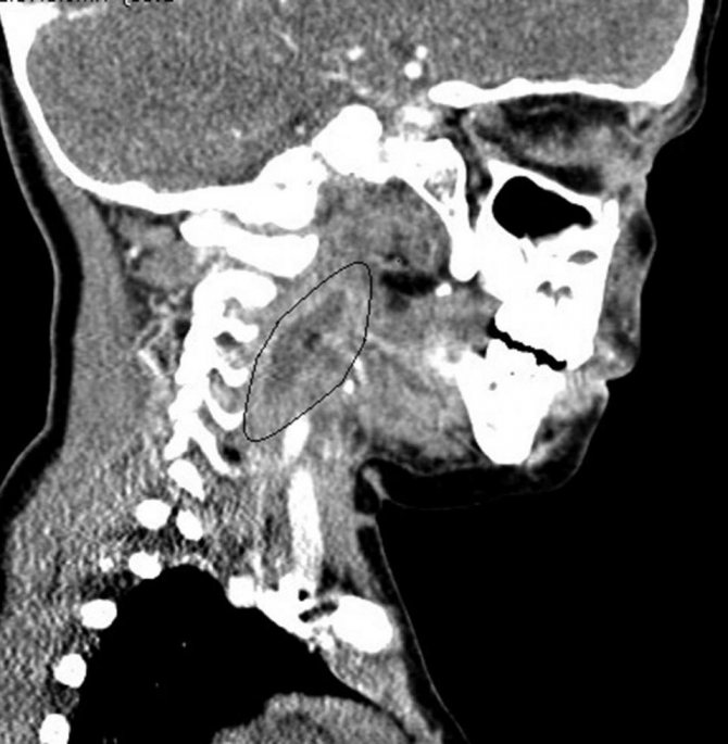 паратонзиллярный абсцесс горла фото