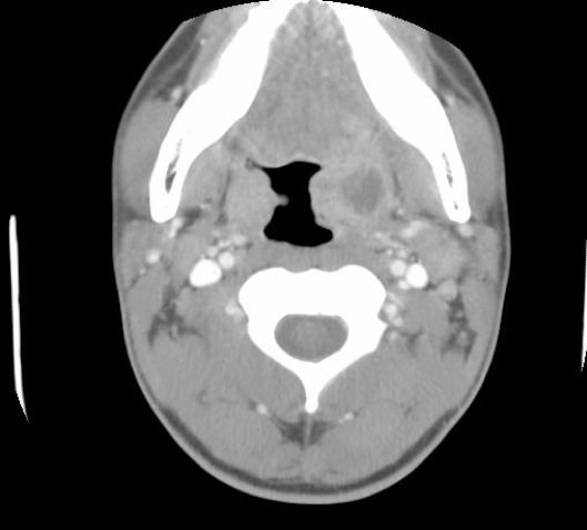 паратонзиллярный абсцесс симптомы и лечение