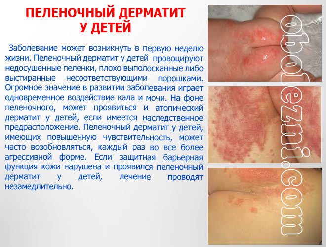 пеленочный дерматит фото