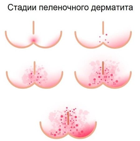 Пеленочный дерматит у новорожденных. Фото, лечение, клинические рекомендации