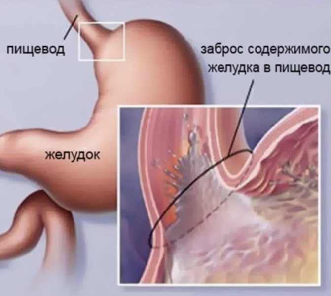 Почему на самом деле появляется изжога и как это исправить