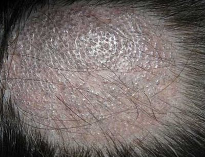 поражение кожи головы грибком трихофитон