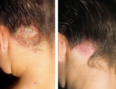 после лечение грибка на голове