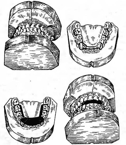 Последовательность изготовления аппарата Брюкля