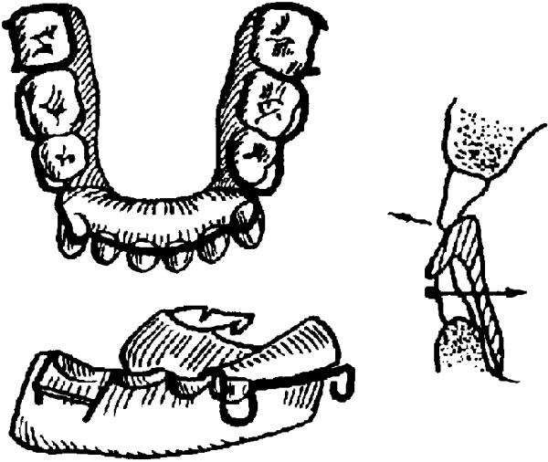 Принцип действия аппарата Брюкля