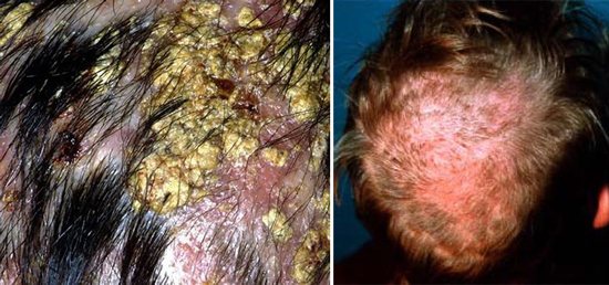 Признаки парши