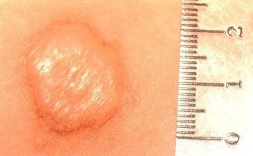 проба манту оценка результата