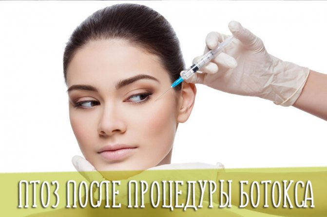 Птоз после процедуры ботокса