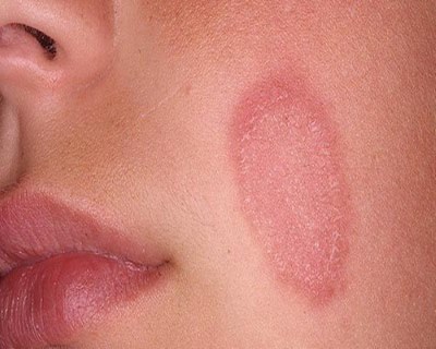 Пятна на лице красного цвета. Шелушатся участки кожи. Лечение кожи