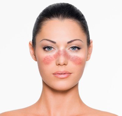 Пятна на лице красного цвета. Шелушатся участки кожи. Лечение кожи