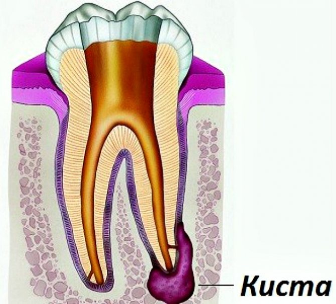 Радикулярная киста