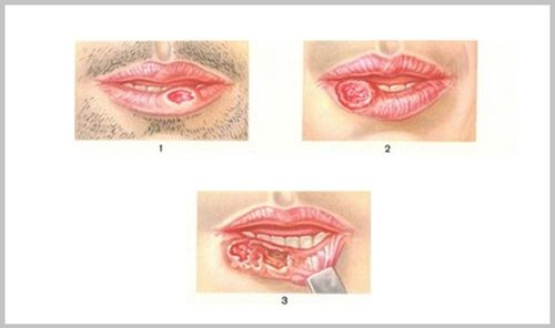 Рак губы от курения