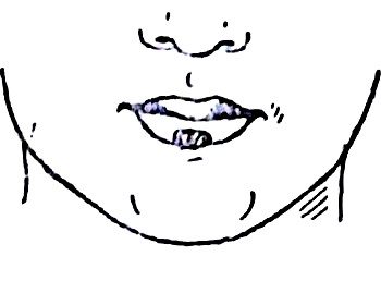 Распространенная локализация рака нижней губы