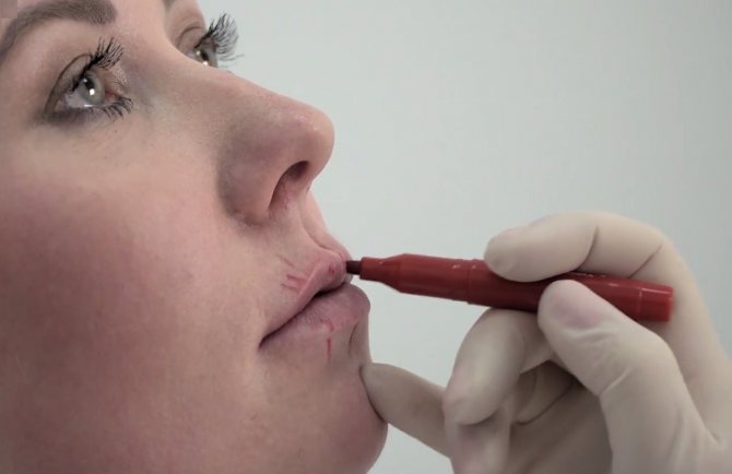 Разметка лица перед введением филлеров