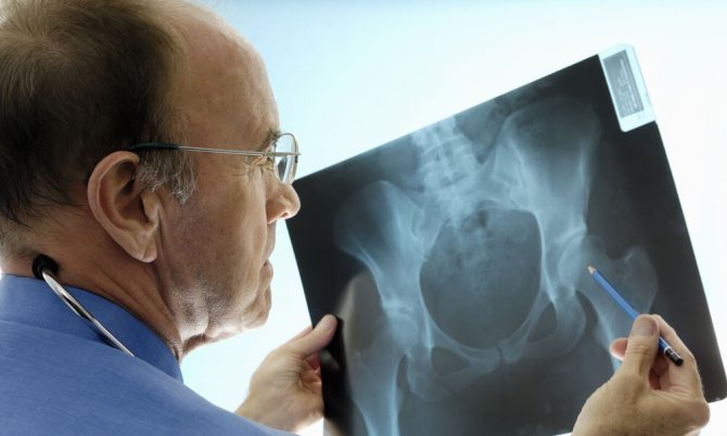 Рентгенологические признаки дисплазии тазобедренных суставов у детей