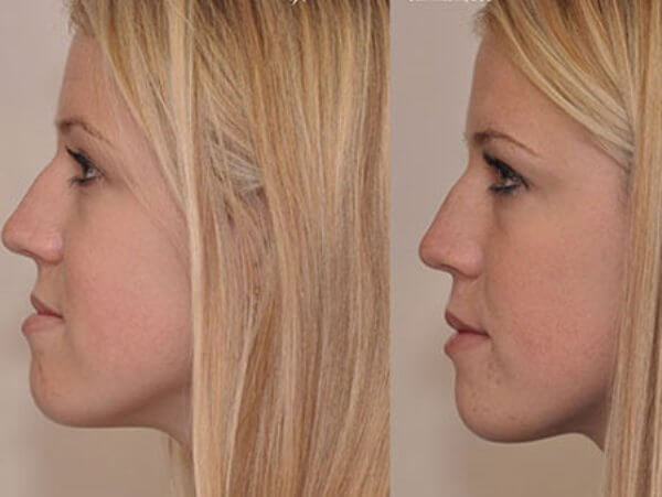 Результат лечения аппаратом Брюкля