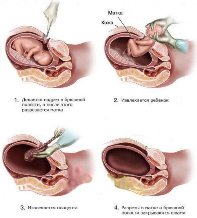 Рождение ребенка при кесаревом сечении