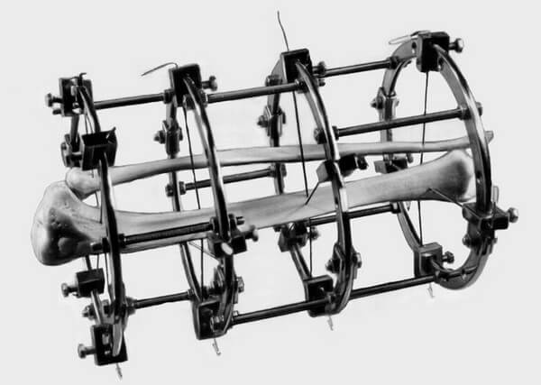 схематичное расположение кости в аппарате