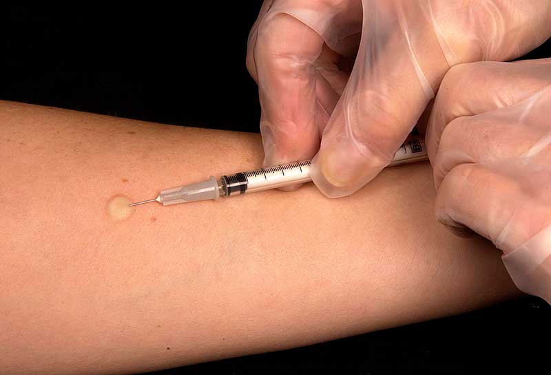 Симптомы и лечение аллергического дерматита у взрослых