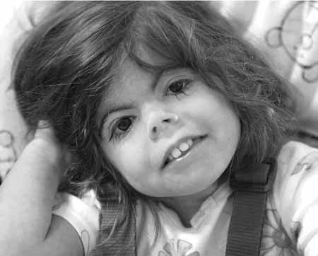 синдром Уильямса является генетическим заболеванием