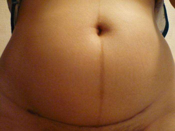 сколько обрабатывать шов после кесарева