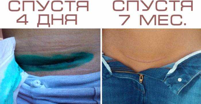сколько обрабатывать шов после кесарева