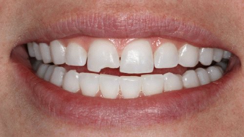 Сонник зубы крошатся и выпадают без крови