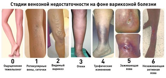 Стадии варикозной болезни нижних конеченостей