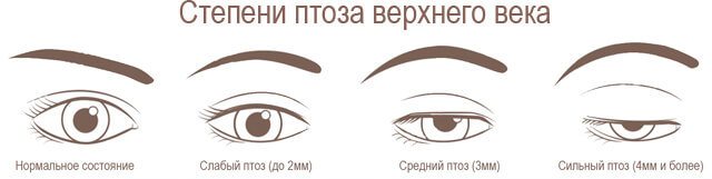 Степени птоза