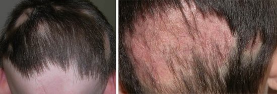 стригущий лишай