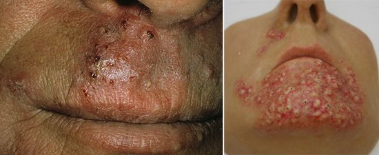 трихофития в области усов и подбородка