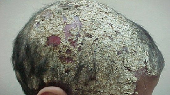 тяжелое течение грибка кожи головы