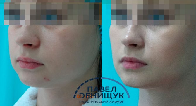 Удаление комков Биша - До и После